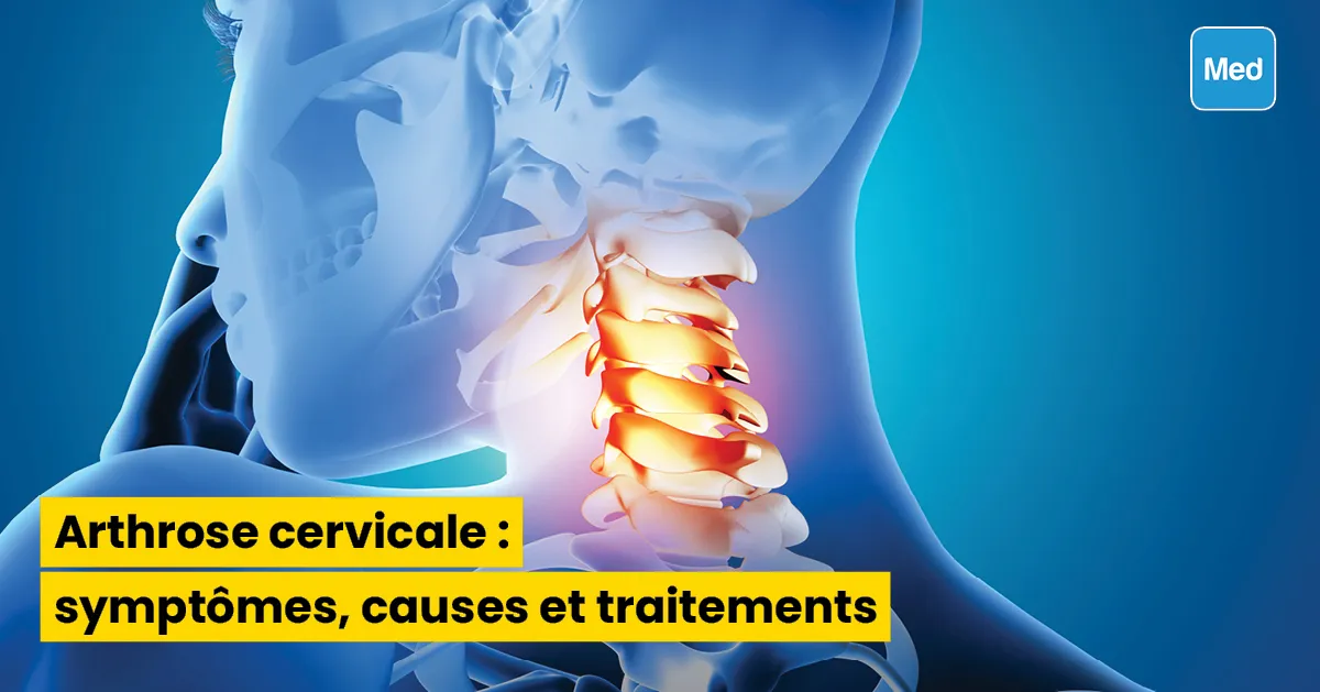 Arthrose cervicale : symptômes, causes et traitements